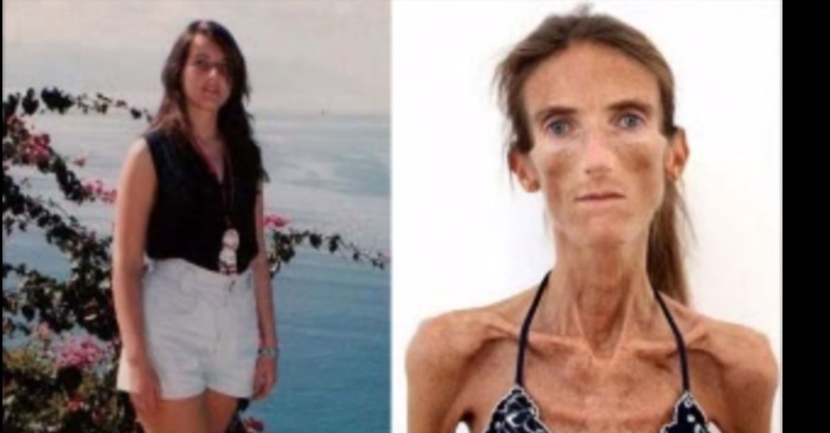 Ella Es Uno De Los Casos De Anorexia Más Graves Que Se Conozcan Y Verla Es Impactante Tronya 1920