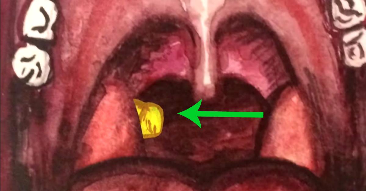 Aprende Sobre Qué Son Los Tonsilolitos Y Cómo Eliminarlos De Tu Boca